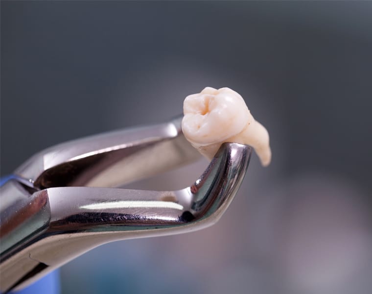 Dr Ashwin Kassan, Wisdom Teeth Removal, Maxillo-facial and Oral Surgeon
