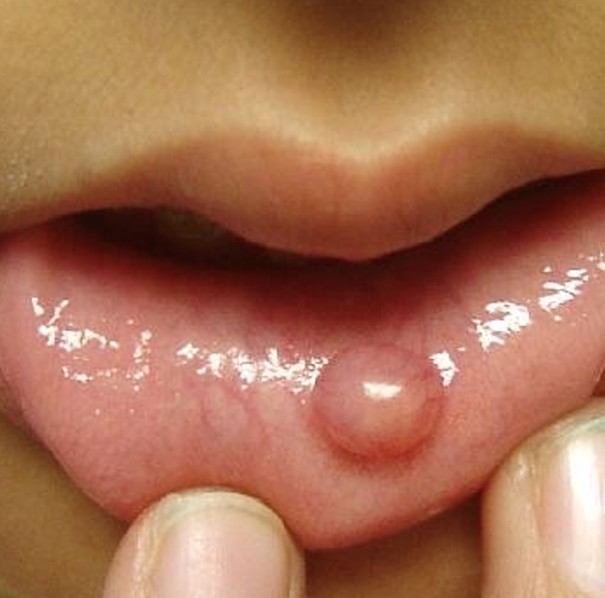 Dr Ashwin Kassan, Oral Pathologies, Maxillo-facial and Oral Surgeon